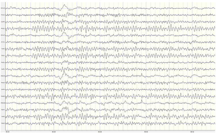 Eyes-closed EEG in longitudinal bipolar montage at 50 microvolts showing posterior rhythm and slow activity patterns